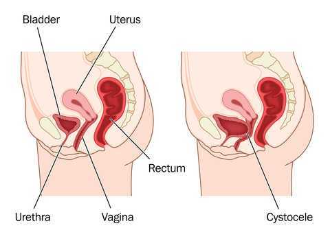 Prolapse and Rehabilitation Part II: Position of Testing for Prolapse